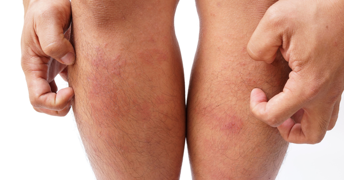 L'eau de douche peut-elle aggraver l'eczéma ?