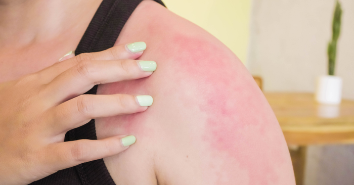 Pourquoi ma peau rougit après la douche ?