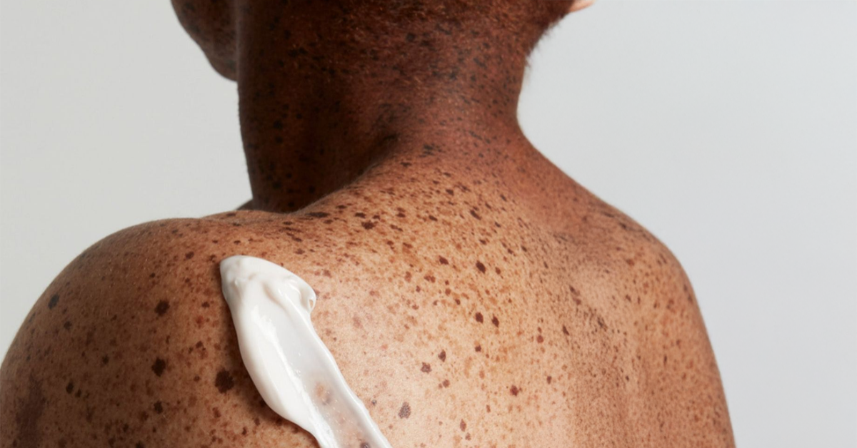 L'eau de douche peut-elle aggraver l'eczéma ?